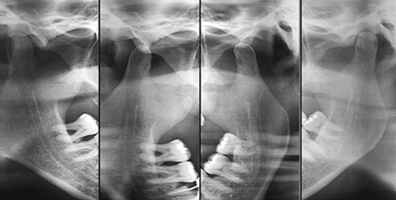 Radiografia de ATM