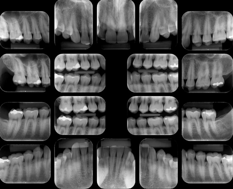 Radiografia Periapical